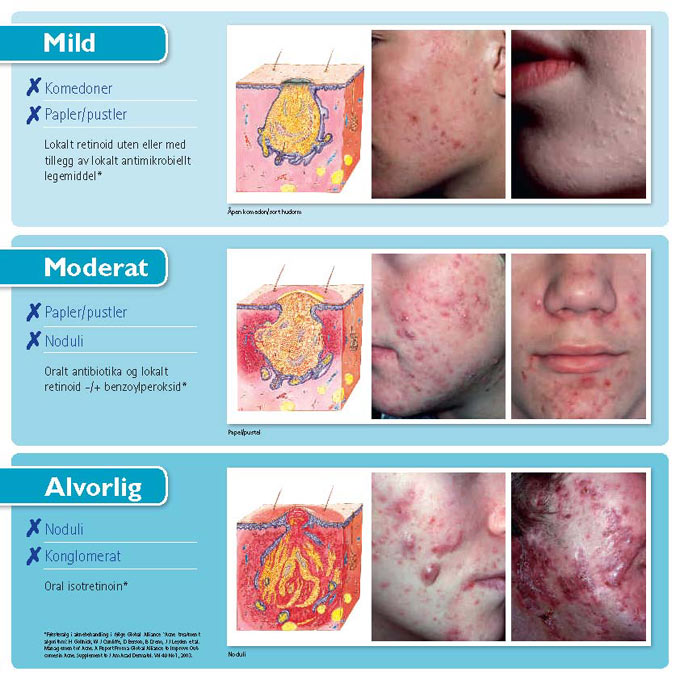 What is Acne? - Acne.org